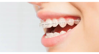 dental braces Adelaide